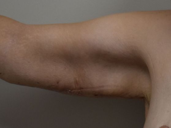 Brachioplasty Case 17 - After