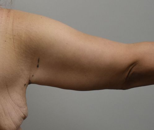 Brachioplasty: Case 17 - After