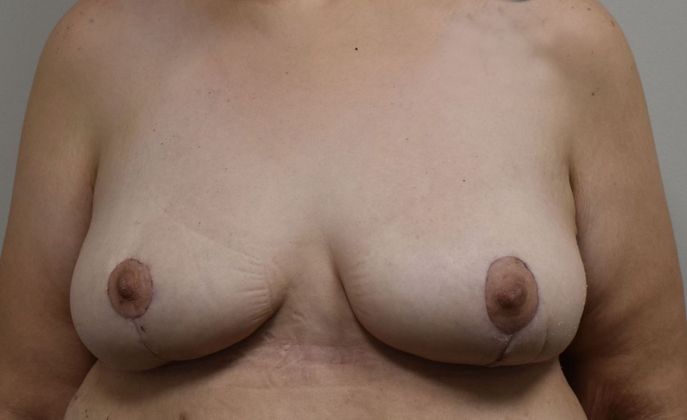 Breast Lift (Mastopexy) Case 132 - After