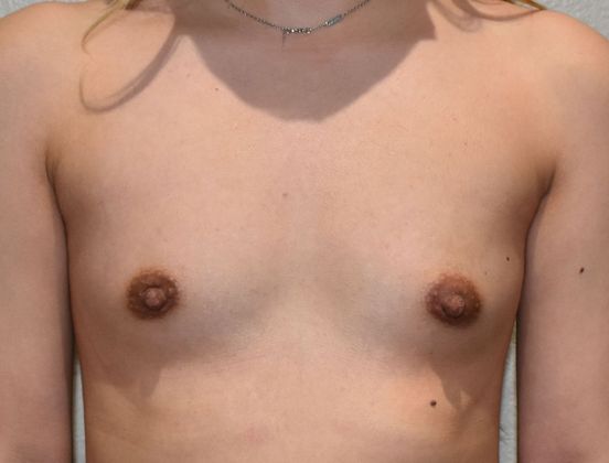 Breast Augmentation Case 677 - Before