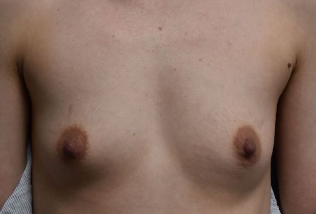 Breast Augmentation Case 678 - Before