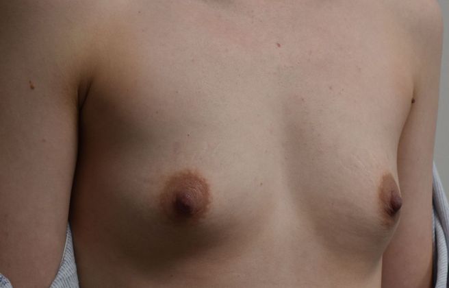 Breast Augmentation: Case 678 - Before