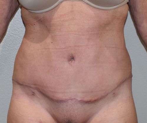 Tummy Tuck (Abdominoplasty): Case 330 - After