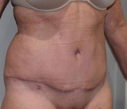 Tummy Tuck (Abdominoplasty): Case 330 - After