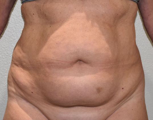 Tummy Tuck (Abdominoplasty): Case 330 - Before