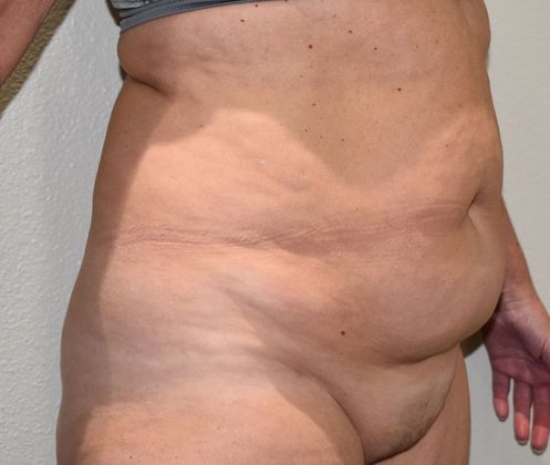 Tummy Tuck (Abdominoplasty): Case 330 - Before