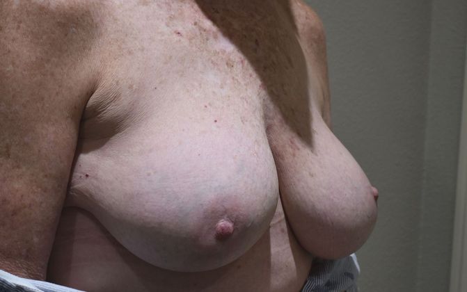 Breast Augmentation w/ Lift: Case 410 - Before