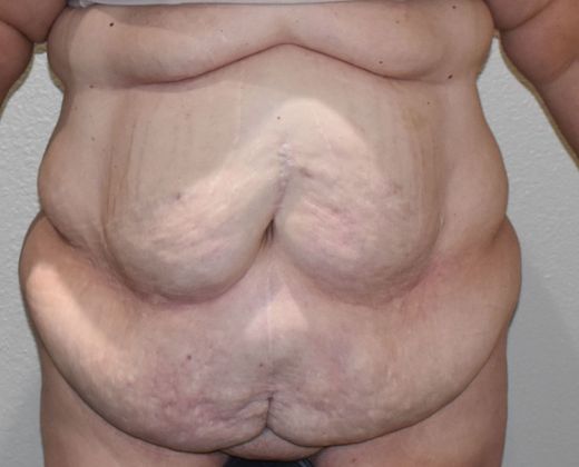 Massive Weight Loss : Case 93 - Before