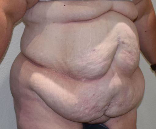 Massive Weight Loss : Case 93 - Before