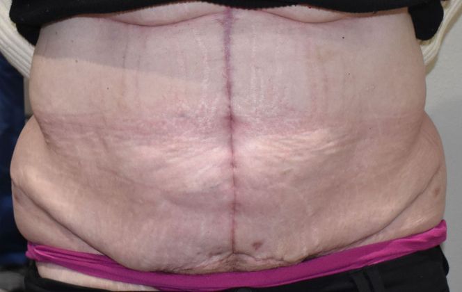 Massive Weight Loss : Case 93 - After