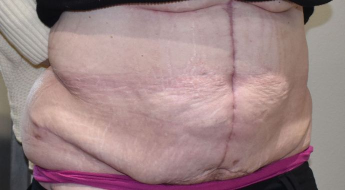 Massive Weight Loss : Case 93 - After