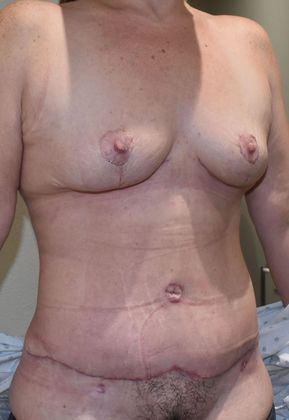 Massive Weight Loss : Case 94 - After