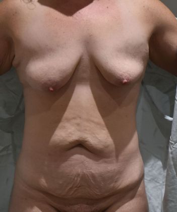 Massive Weight Loss : Case 94 - Before