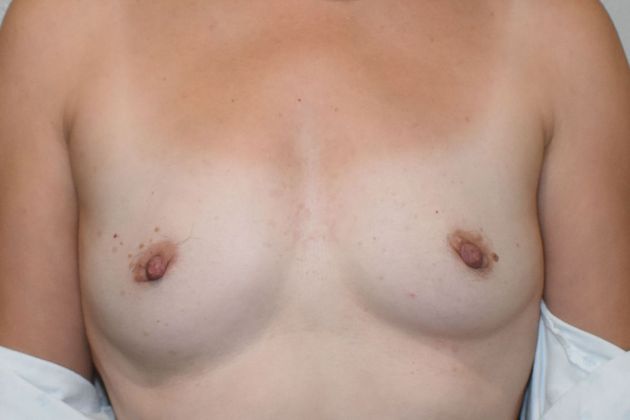 Breast Augmentation Case 20 - Before