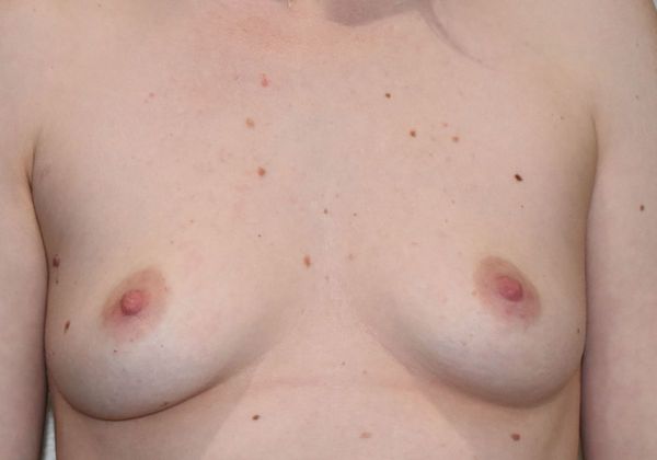 Breast Augmentation Case 680 - Before