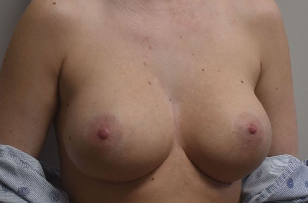 Breast Augmentation: Case 680 - After