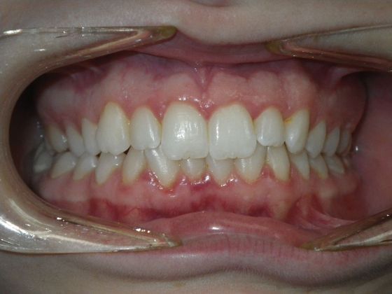 Orthodontics Case 33 - Before