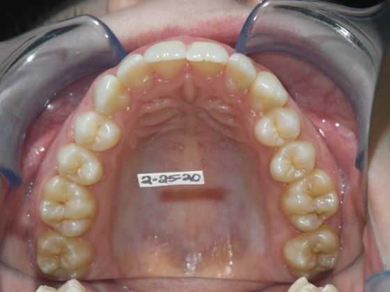 Orthodontics: Case 33 - Before