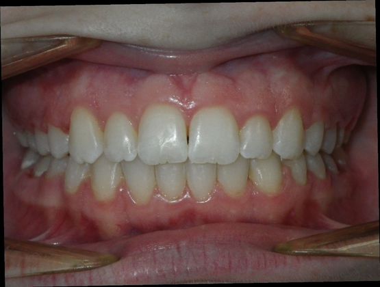 Orthodontics Case 33 - After
