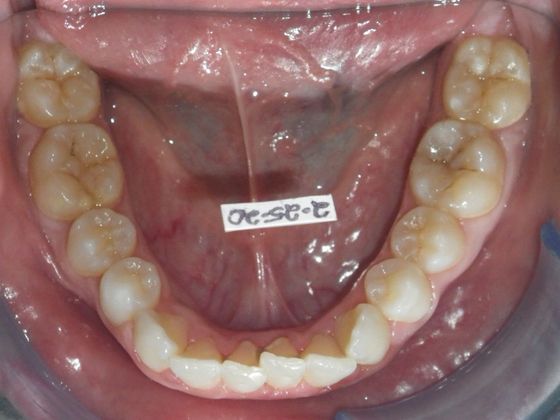 Orthodontics: Case 33 - Before