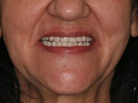 All-on-4/ Full Mouth Dental Implants / Teeth in a Day: Case 12-HM-Upper and lower All-on-4 bridges - After