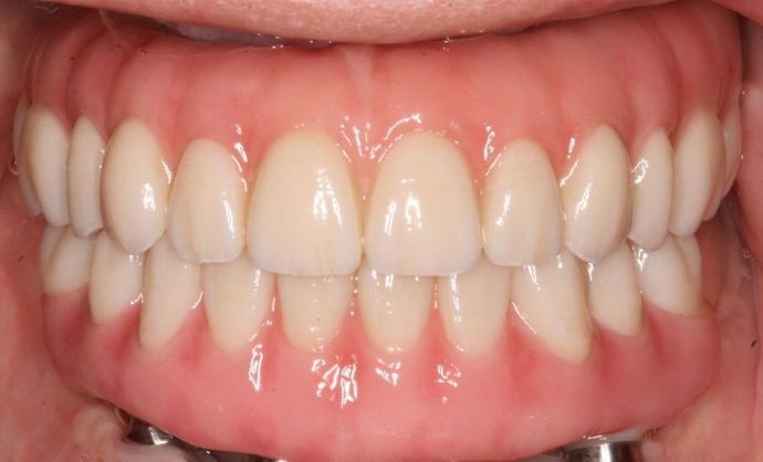 All-on-4/ Full Mouth Dental Implants / Teeth in a Day: Case 12-HM-Upper and lower All-on-4 bridges - After