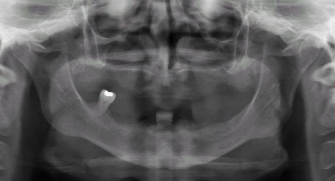 All-on-4/ Full Mouth Dental Implants / Teeth in a Day: Case 12-HM-Upper and lower All-on-4 bridges - Before