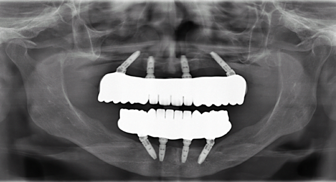 All-on-4/ Full Mouth Dental Implants / Teeth in a Day: Case 12-HM-Upper and lower All-on-4 bridges - After