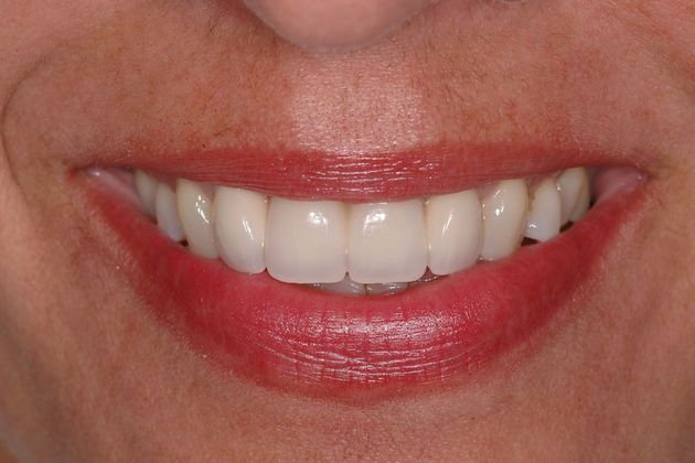 Porcelain bridges: Natalie - After