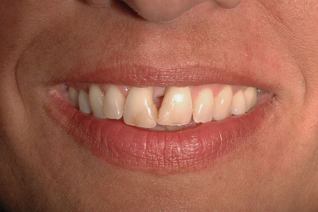 Porcelain bridges: Natalie - Before