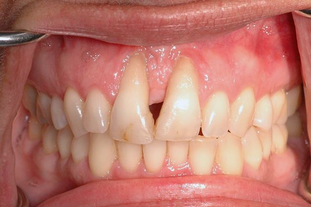 Porcelain bridges: Natalie - Before