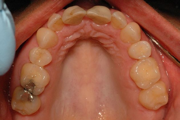 Porcelain bridges: Natalie - Before