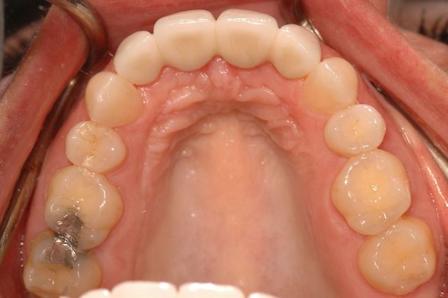 Porcelain bridges: Natalie - After