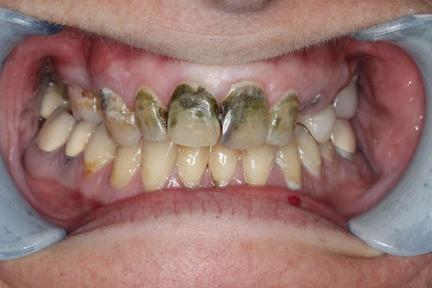Dentures: Case 7 - Before