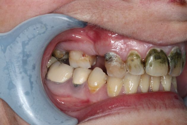 Dentures: Case 7 - Before