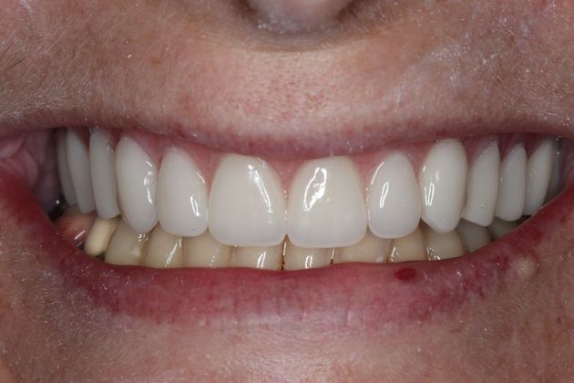 Dentures: Case 7 - After