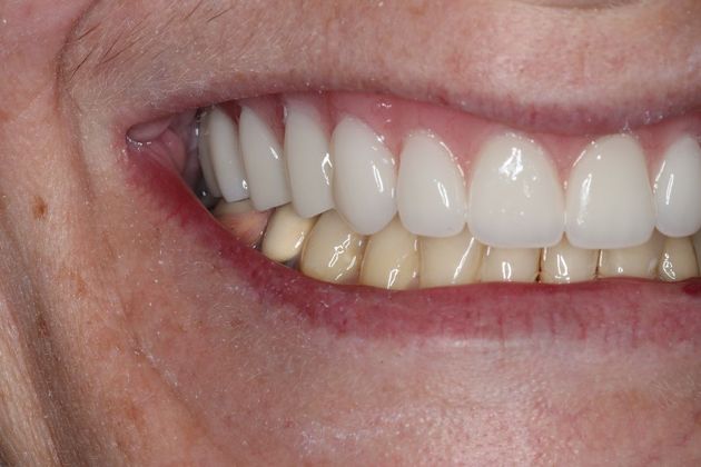 Dentures: Case 7 - After