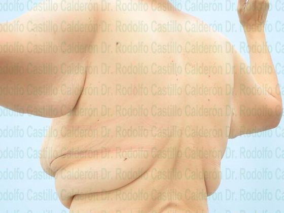 Upper Body Lift: Arm Lift + Breast Lift + Posterior Upper Body Lift - Before