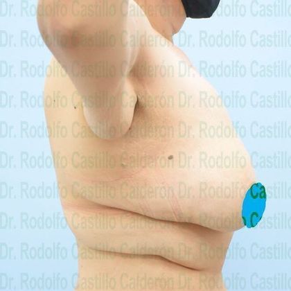 Upper Body Lift Arm Lift + Breast Lift + Posterior Upper Body Lift - Before