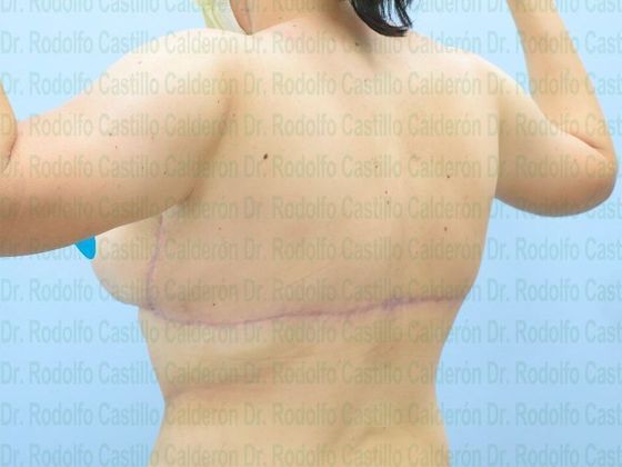 Upper Body Lift: Arm Lift + Breast Lift + Posterior Upper Body Lift - After