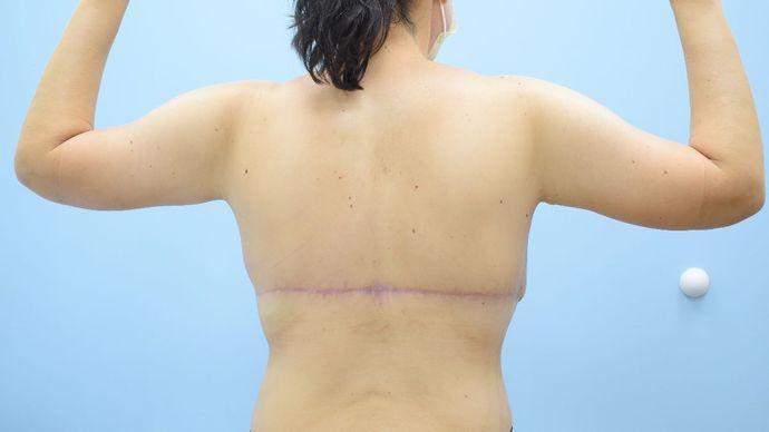 Upper Body Lift: Arm Lift + Breast Lift + Posterior Upper Body Lift - After