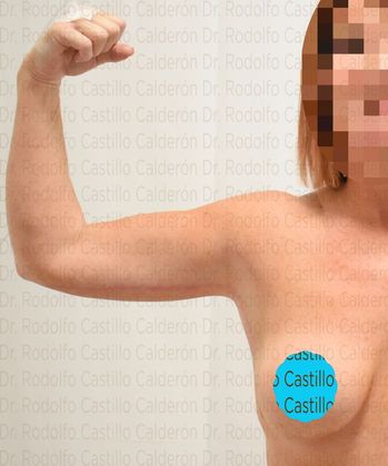 Upper Body Lift Secondary Arm Lift + Breast Augmentation after mastopexy - After