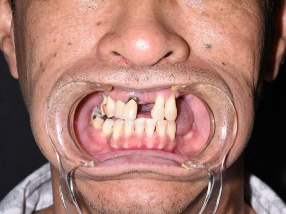 All on 4 (Full Arch Implant Cases) Case 8:  Upper and Lower All on 4  - Before