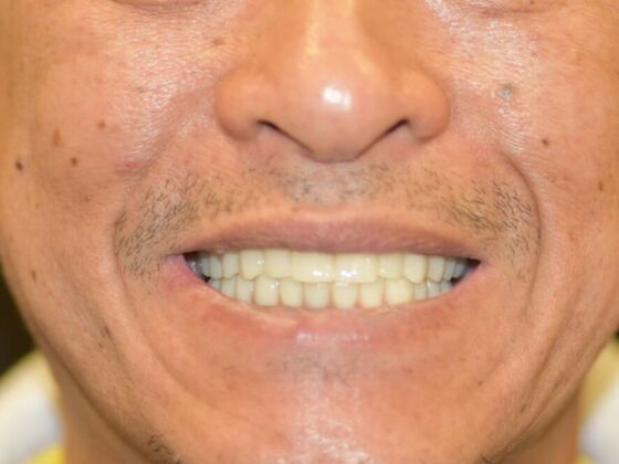 All on 4 (Full Arch Implant Cases) Case 8:  Upper and Lower All on 4  - After