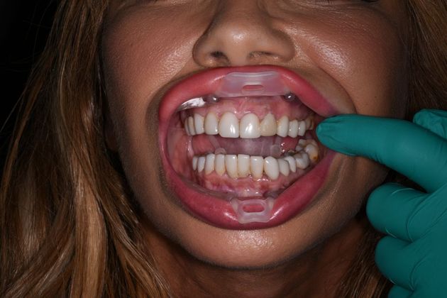 All on 4 (Full Arch Implant Cases) Case 9: Upper and Lower All on 4 - Before