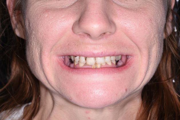 All on 4 (Full Arch Implant Cases) Case 10: Upper and Lower All on 4 (full implant case) - Before