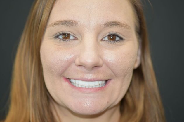 All on 4 (Full Arch Implant Cases) Case 10: Upper and Lower All on 4 (full implant case) - After