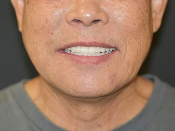 All on 4 (Full Arch Implant Cases): Case 11: Upper and Lower All on 4 - After