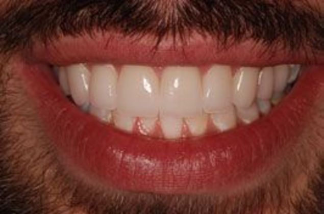Veneers: Steve H. - After