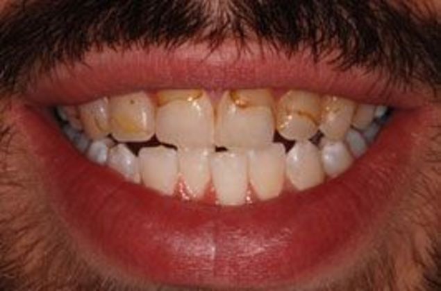 Veneers: Steve H. - Before